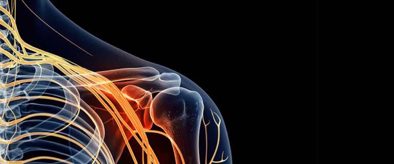 Brachial Plexus Tumors / Spinal Nerve Root Tumors