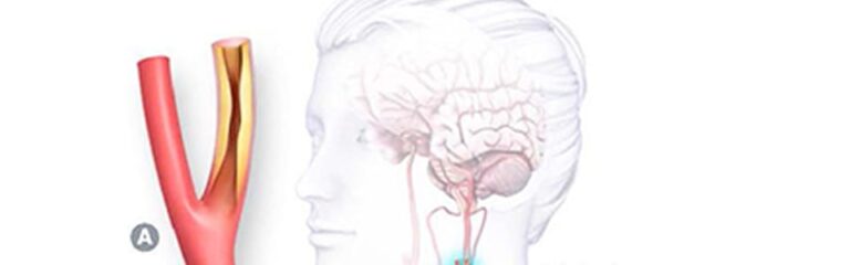 Carotid Stenosis