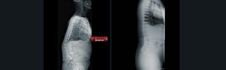 Spinal Deformity – Sagittal Imbalance