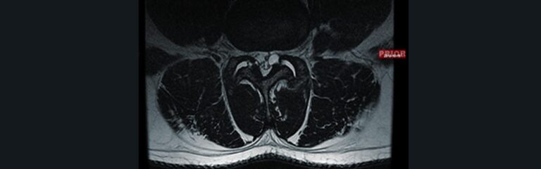 Degenerative Disc Disease