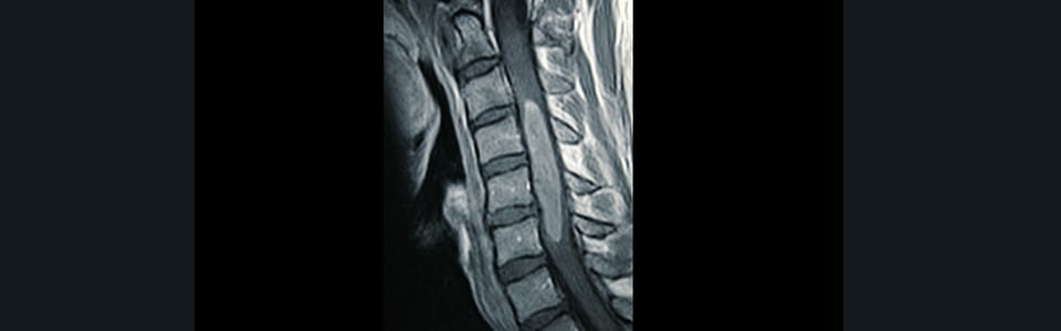 Spinal Tumors