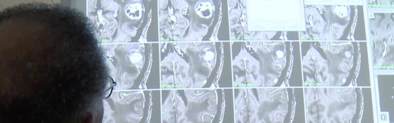 Stereotactic Neurosurgical Procedures