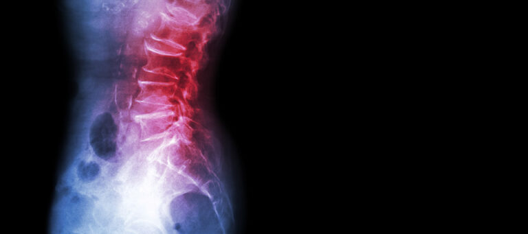 Spondylolisthesis