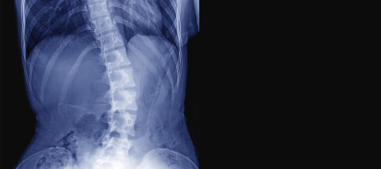 Idiopathic Scoliosis