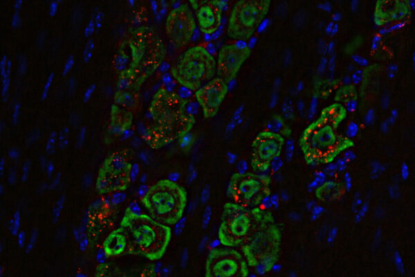 Nasal drops fight brain tumors noninvasively