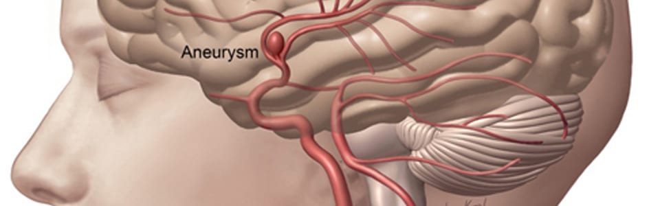 How Long Does A Aneurysm Surgery Take