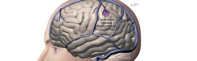 Cavernous Malformation