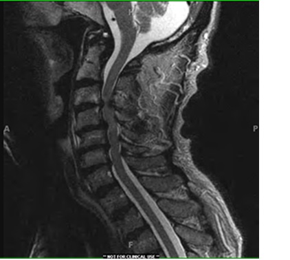 Cervical spinal stenosis  Neurosurgery Inselspital Bern