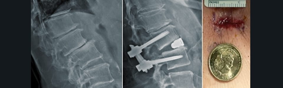 Minimally-Invasive Spine Surgery
