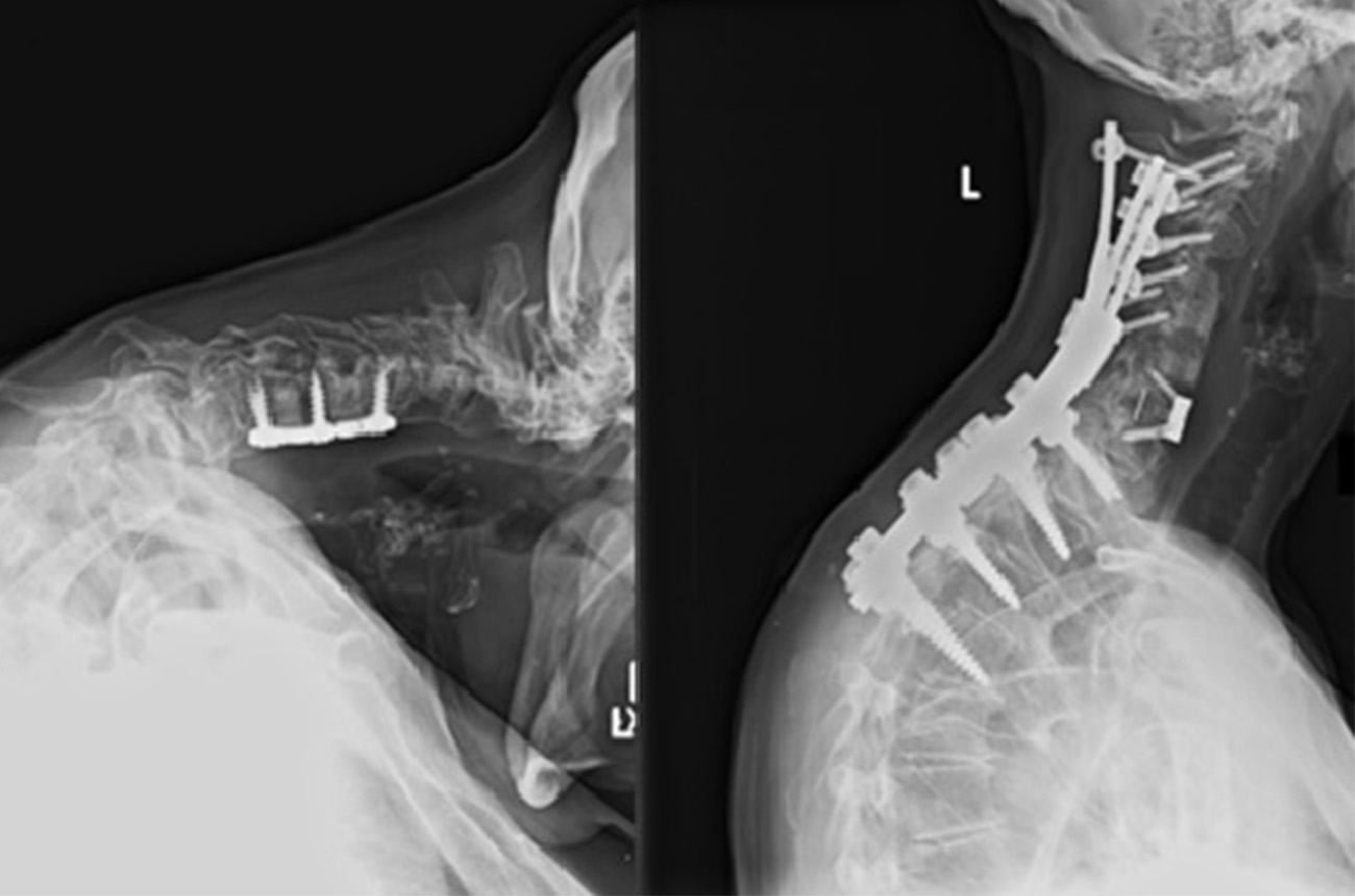 Cervical deformity before surgery with post-surgery correction.