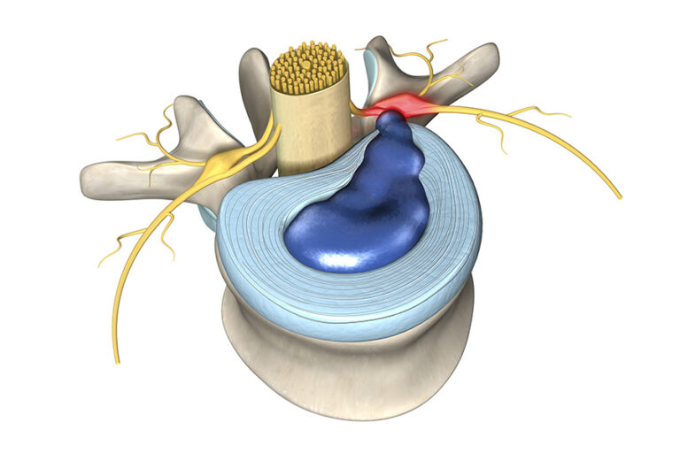 Cervical Disc Herniation, Cervical Radiculopathy and Cervical