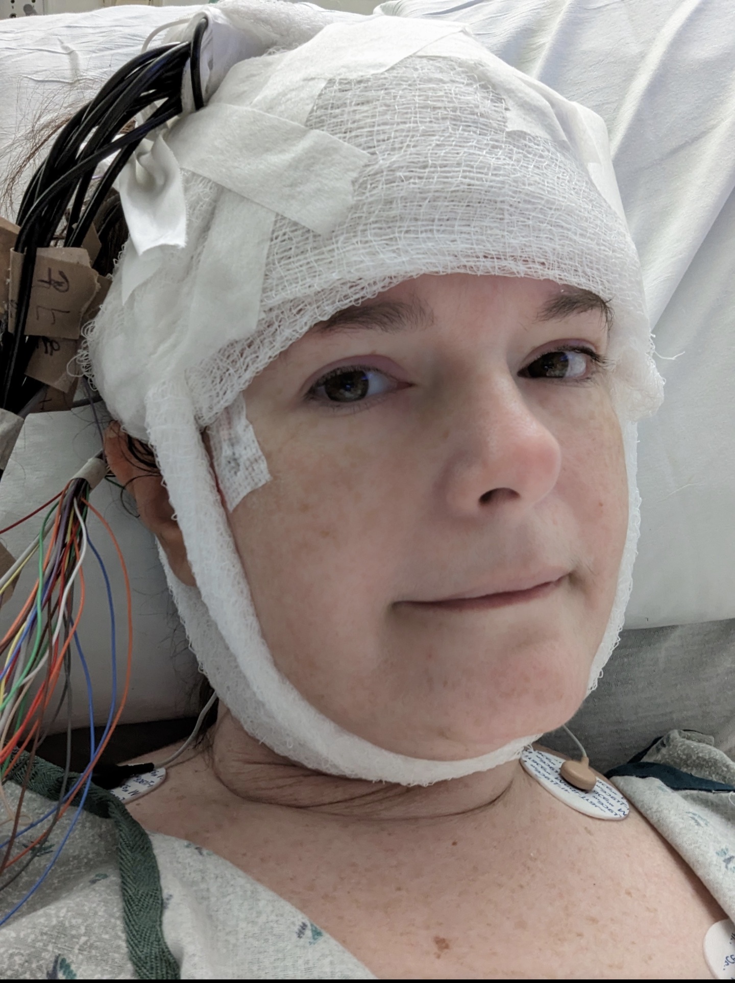 Singing a new song: surgery as a curative option for epilepsy - Taylor ...