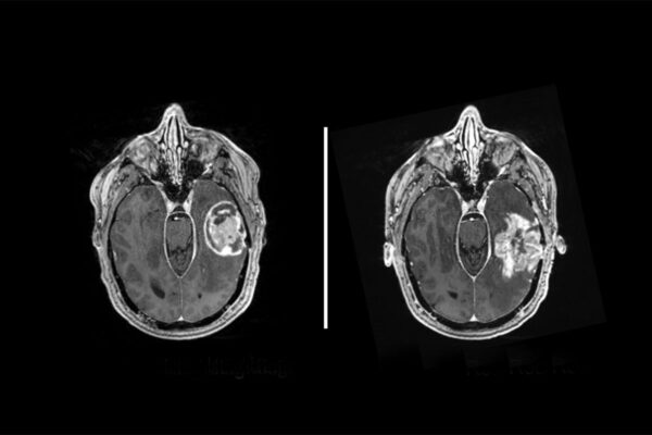 Researchers make glioblastoma cells visible to attacking immune cells